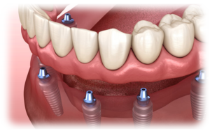 A diagram of All-on-4 implant supported dentures.
