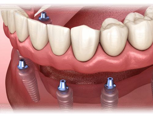 The All-on-Four Advantage: A Faster, More Affordable Path to a Full Smile
