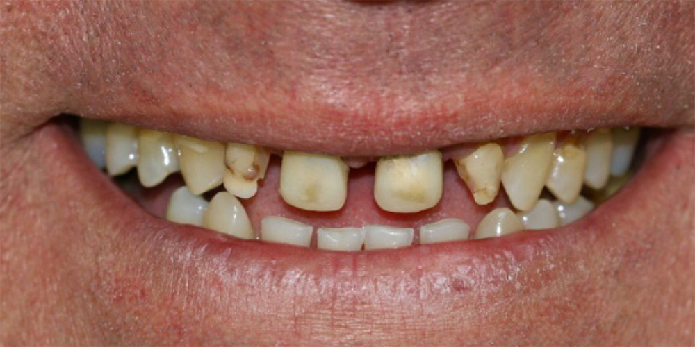 Before