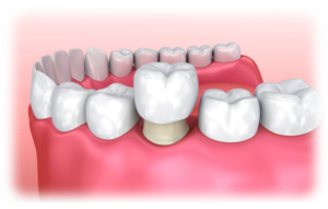 A graphic image of a dental crown being applied over a tooth.