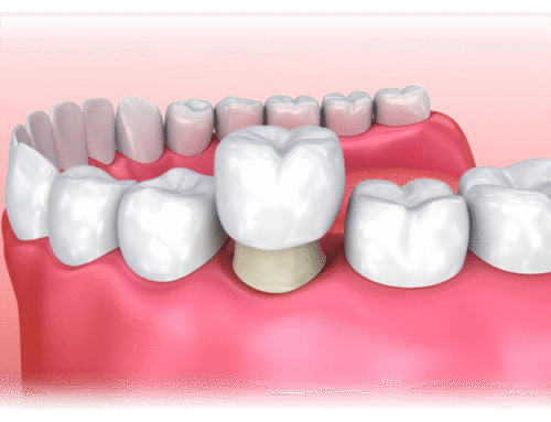 Dental Disaster? Here’s When to Call Springs Dentistry Fast
