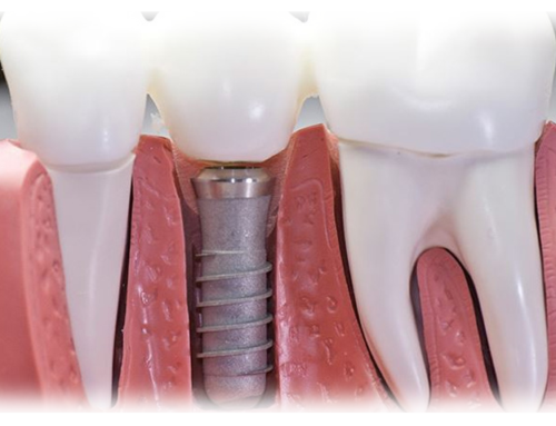 A Missing Tooth Doesn’t Have to Steal Your Smile