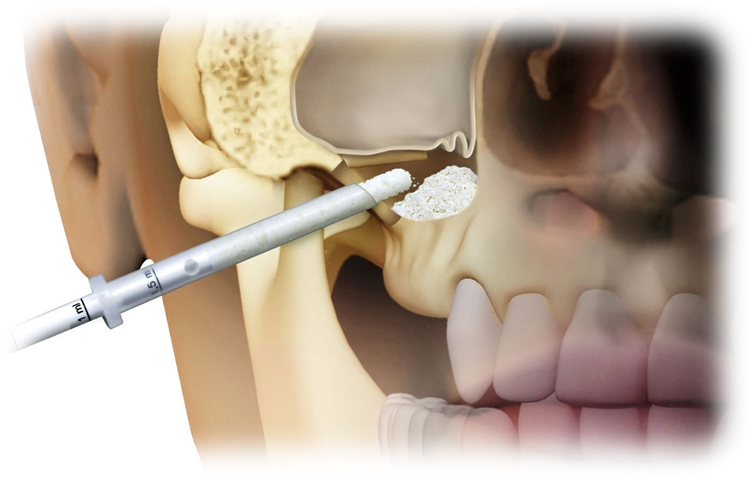 sinus_lift