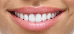 A close-up of a woman's smile after porcelain veneers.