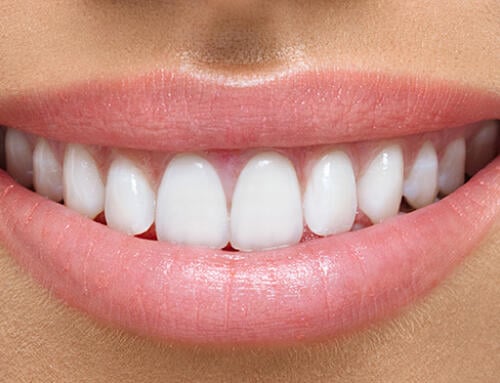 From Stained to Stunning: Veneers That Transform