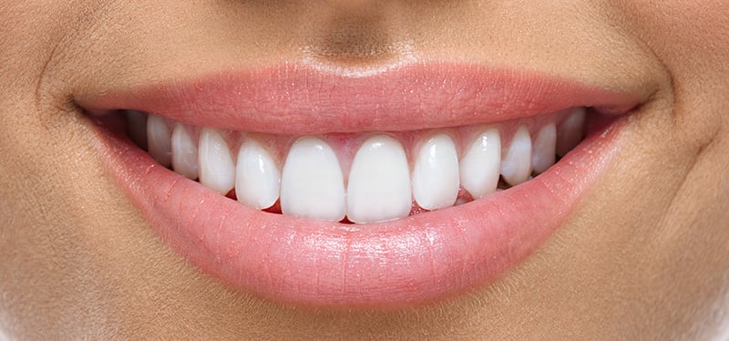 A close-up of a woman's smile after porcelain veneers.