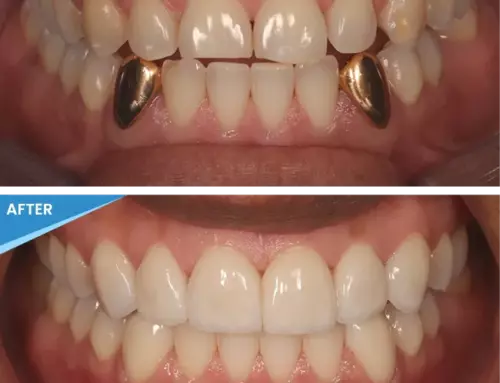Show Off Your Best Smile Yet — Get a Smile Makeover at Springs Dental!