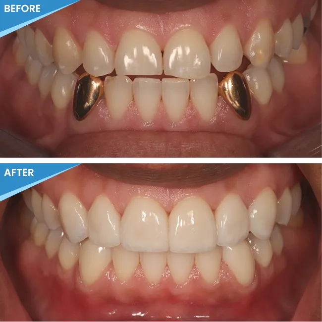 Before and after image of a Springs Dental smile makeover patient.