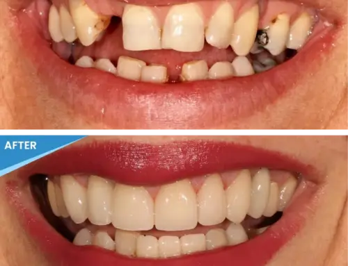 Reclaim Your Smile with Full Mouth Reconstruction