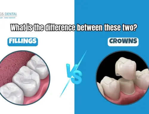 What is the difference between fillings vs crowns in Miami Springs, FL
