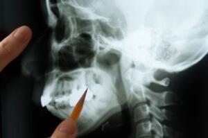 A person pointing with a pencil to an X-ray of a jawbone.