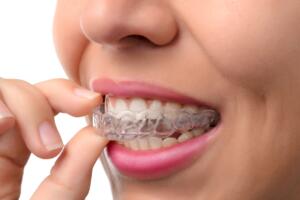 A woman inserting a clear aligner for subtle smile improvement.