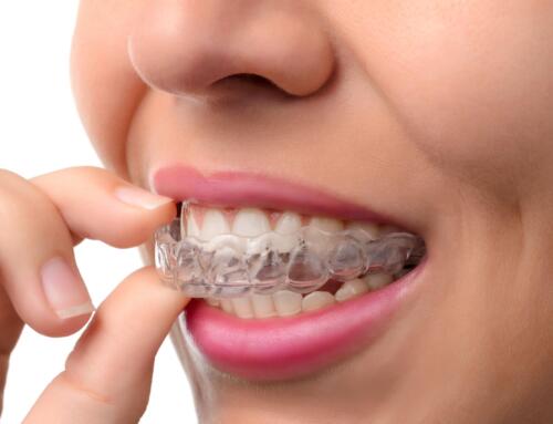Subtle Transformations: The Magic of Invisalign