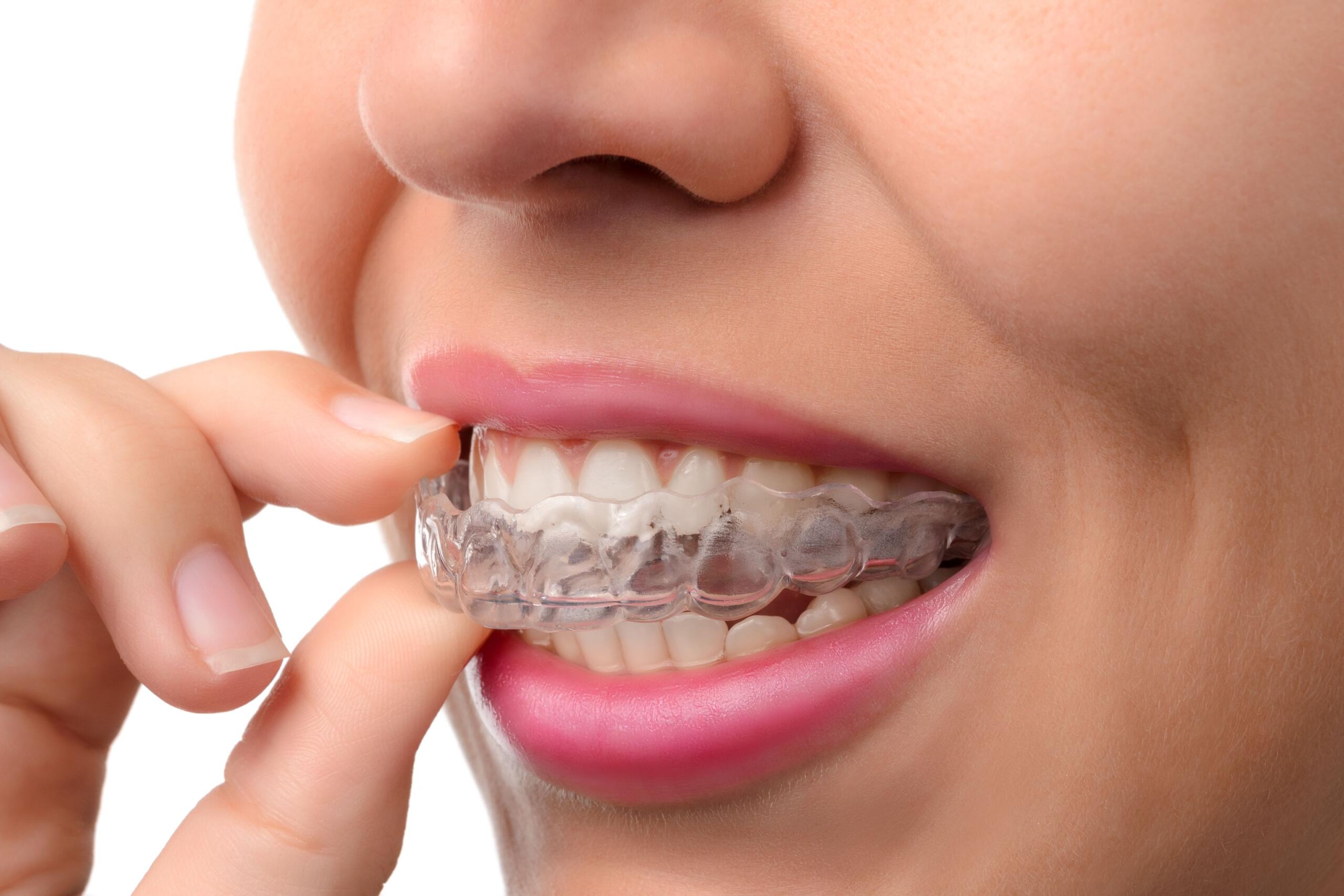A woman inserting a clear aligner for subtle smile improvement.